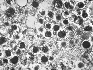 F,68y. | APUD carcinoma F,68y. | APUD carcinoma